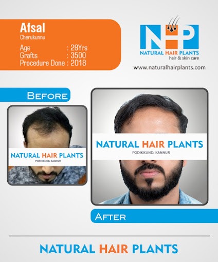 Hair Transplantation Result 1