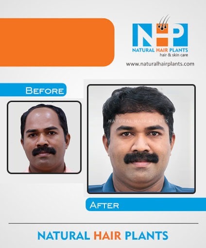 Hair-Transplantation-Result-11