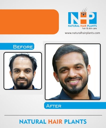 Hair-Transplantation-Result-12