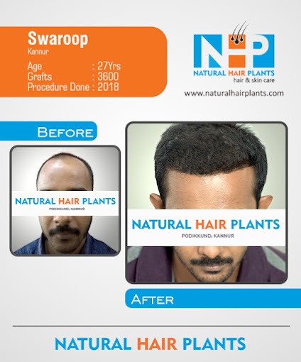 Hair Transplantation Result 14