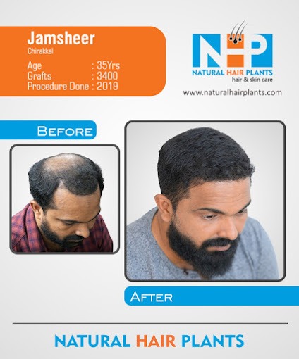 Hair-Transplantation-Result-8