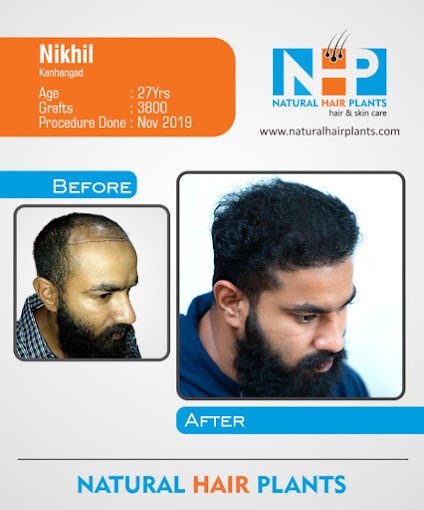 Hair-Transplantation-Result-9