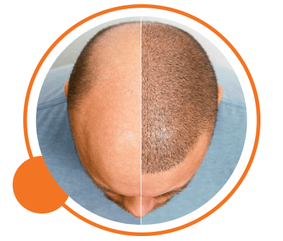 Hair Transplant Clinic in Calicut